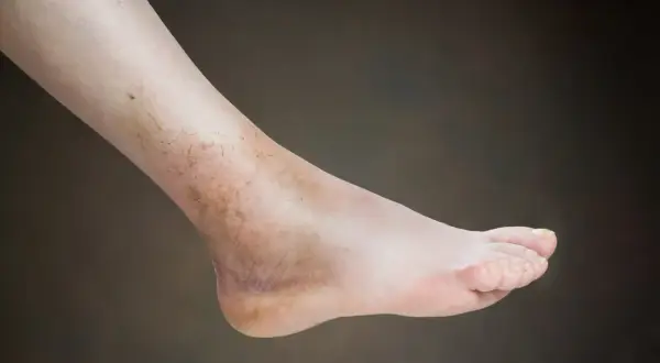 Noga po skręceniu: Kiedy ból minie i jak przyspieszyć gojenie?