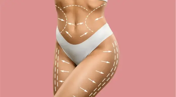 Co to liposukcja? Przewodnik po metodach, efektach i kosztach