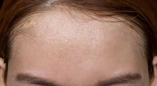 Skóra czoła z widocznymi porami i błyszczącym efektem, który może być spowodowany nadmiarem sebum. Co to jest sebum i jak sobie z nim radzić?