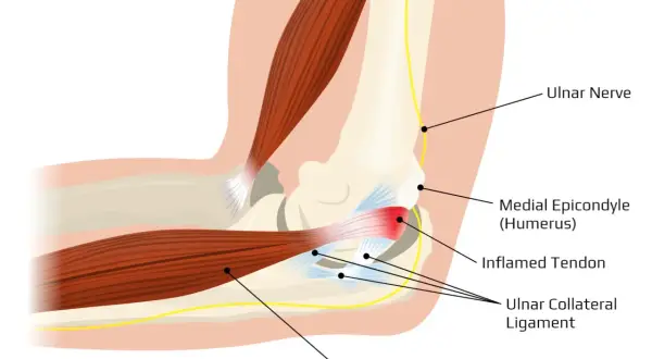 Anatomia łokcia z zapaleniem ścięgna, więzadła pobocznego łokciowego i nerwu łokciowego. Ból łokcia może być spowodowany stanem zapalnym.
