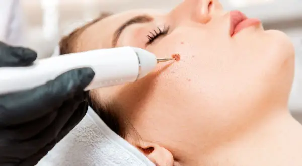 Zabieg elektrokoagulacji dermatologicznej usuwa znamiona na twarzy.