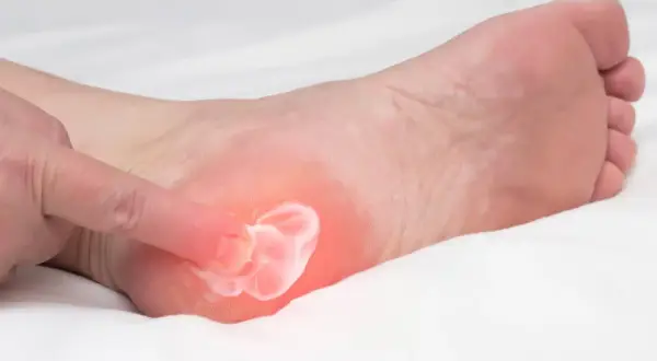 Application d'une crème sur une zone rouge et douloureuse du talon, suggérant une aponévrosite plantaire qui ne guérit pas.
