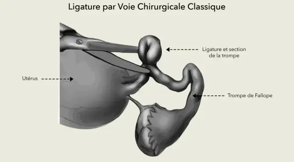 Illustration d'une ligature des trompes par voie chirurgicale classique, montrant l'utérus et une trompe de Fallope ligaturée et sectionnée.