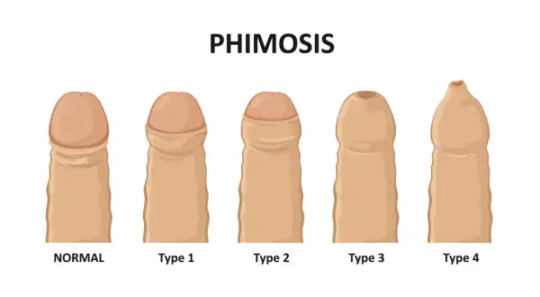 Różne stopnie stulejki (phimosis): od normalnego, przez typ 1, 2, 3, aż po typ 4, gdzie napletek jest mocno zwężony.
