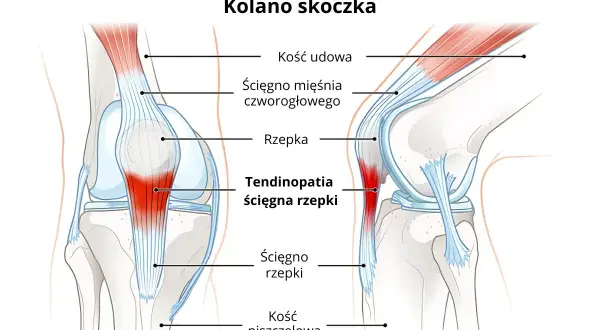 Ilustracja anatomiczna kolana z zaznaczoną rzepką i ścięgnem, z obszarem zapalenia.