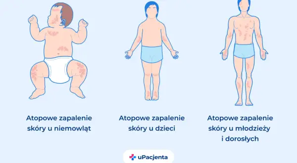 Ilustracja pokazuje, jak egzema u dzieci objawia się na skórze niemowlęcia, dziecka i młodego dorosłego.