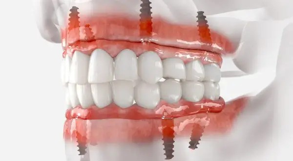 Model szczęki z implantami zygomatycznymi, pokazujący mocowanie protezy na implantach.