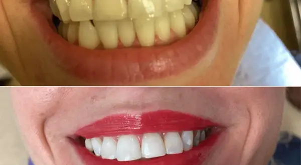 Wybielanie zębów u dentysty: Koszt, efekty i bezpieczeństwo. Poznaj fakty.