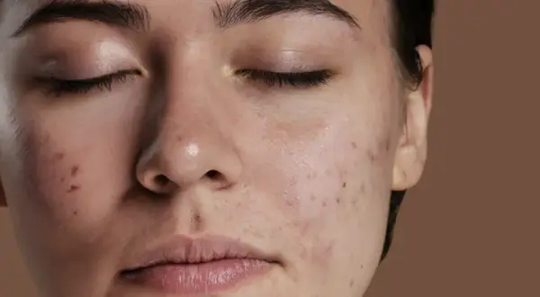 Primo piano del viso di una giovane donna con diversi tipi di imperfezioni viso, tra cui brufoli e macchie rosse.