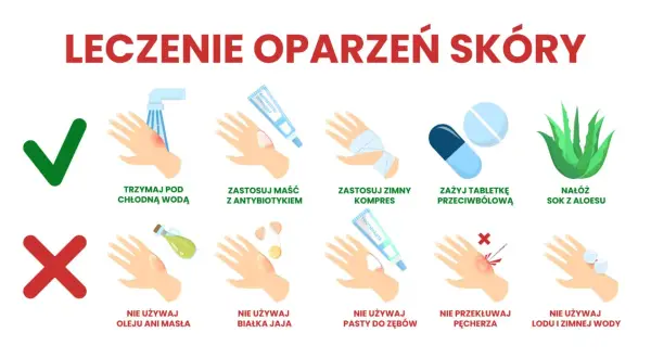 Porady dotyczące leczenia oparzeń skóry: chłodna woda, maść z antybiotykiem, zimny kompres, leki przeciwbólowe, aloes. Unikaj masła, jajka, pasty do zębów, przekłuwania pęcherzy i lodu.