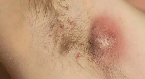 Duży, zaczerwieniony ropień pod pachą, przypominający objawy mastitis. Widać drobne krostki i włosy.
