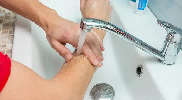 Arm unter fließendem Wasser kühlen. Bei einer Brandblase sofort handeln: Kühlen ist das Wichtigste.