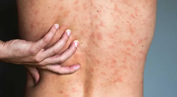 Une main gratte le dos couvert de plaques rouges, signe d'urticaire après la douche.