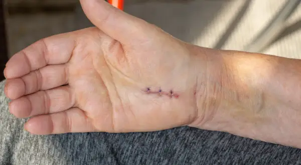 Dłoń z kilkoma szwami po operacji. Widać zaczątki blizny przerostowej, która może wymagać dalszej pielęgnacji.