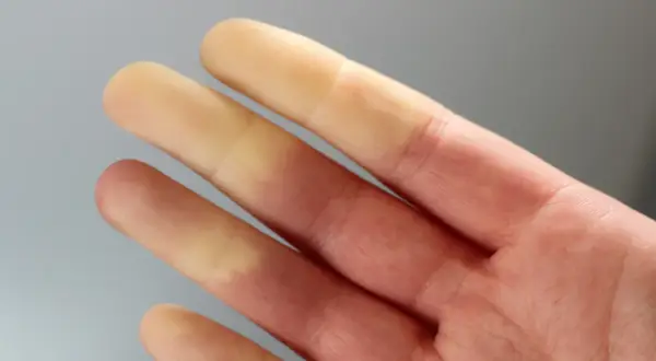 Palce dłoni z widocznymi zmianami koloru, wskazującymi na zespół Raynauda.