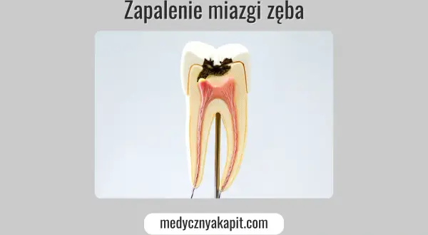 Model zęba z widocznym ubytkiem i zapaleniem miazgi. Objawy zapalenia miazgi mogą być bolesne.