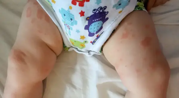 Czerwone plamy na skórze dziecka, widoczne na udach i wokół pieluszki, mogą wskazywać na uczulenie na mleko modyfikowane.