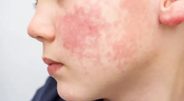Visage d'enfant marqué par une rougeur diffuse et des plaques, symptômes d'une allergie pollen visage.