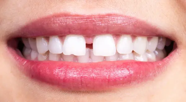 Labbra rosse e sorridenti rivelano un diastema tra i denti, uno spazio che rende unico il sorriso.