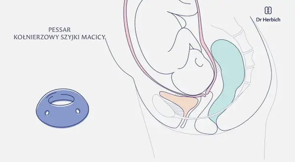 Skracanie szyjki macicy w ciąży: Jak zapobiec przedwczesnemu porodowi?