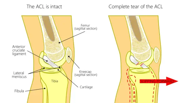 Anatomia kolana: zerwane więzadło krzyżowe przednie (ACL) powoduje przesuwanie się kości. Ltc kolano co to jest – ilustracja pokazuje uszkodzenie ACL.