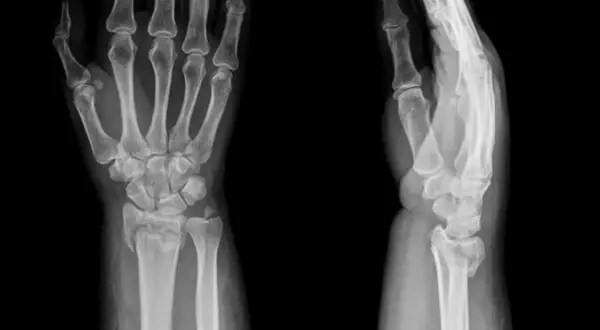 Radiographies du poignet montrant une fracture. L'image de gauche est de face, celle de droite de profil.