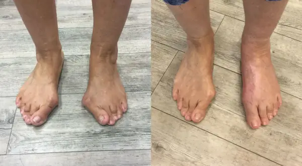 Vorher-Nachher-Vergleich von Füßen mit Hallux valgus, rechts nach Lapidus Arthrodese.