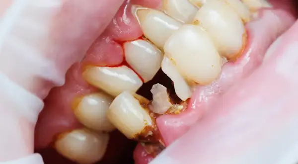 Denti con evidenti crepe e carie, gengive infiammate e sanguinanti. Un quadro preoccupante di salute orale.
