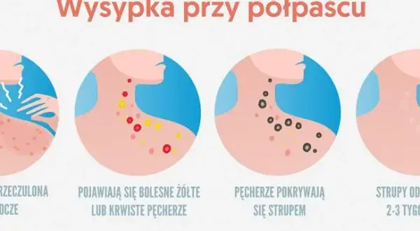Półpasiec objawy u dziecka: Jak rozpoznać i uniknąć powikłań
