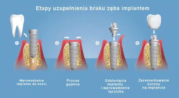Jak wygląda implant zęba? Wszystko o budowie i procesie wszczepiania