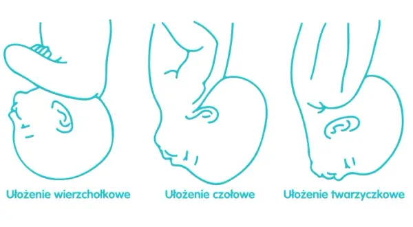 Jak rozpoznać ułożenie dziecka do porodu i uniknąć komplikacji?