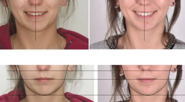 Czy aparat na zęby naprawdę zmienia kształt twarzy? Sprawdź, jak wpływa na rysy