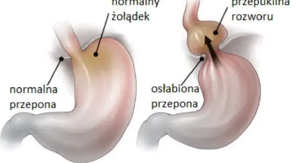 Przepuklina jaki lekarz - kogo wybrać, aby uniknąć problemów zdrowotnych