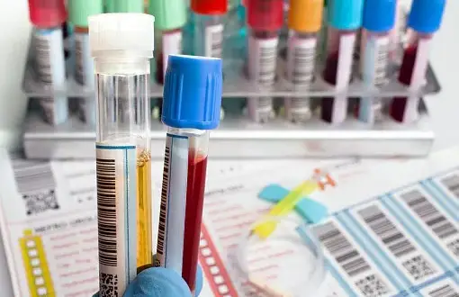 Cholesterol czy na czczo? Co musisz wiedzieć przed badaniem krwi