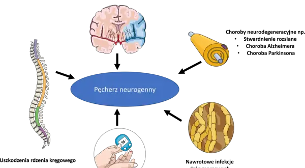 Ilustracja przedstawia przyczyny pęcherza neurogennego: mózg, rdzeń kręgowy, nerw, cukrzycę i bakterie. Czy pęcherz neurogenny da się wyleczyć?