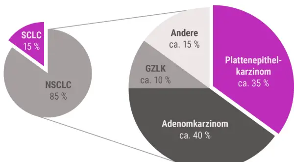 Diagramm zeigt Lungenkrebs-Arten: NSCLC (85%) und SCLC (15%). NSCLC unterteilt in Adenokarzinom (40%), Plattenepithelkarzinom (35%), GZLK (10%) und Andere (15%). Hoffnungsvolle lungenkrebs geheilt erfahrungsberichte sind hier relevant.