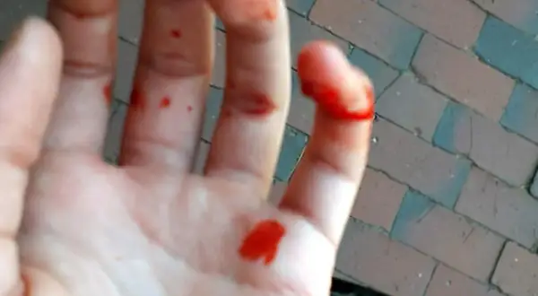Blutige Hand mit einem offensichtlich gebrochenen Finger. Kleine Schnitte und Blutstropfen auf der Handfläche und den Fingern.