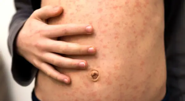 Un abdomen infantil cubierto de pequeños puntos rojos, mostrando varios tipos de sarpullidos.