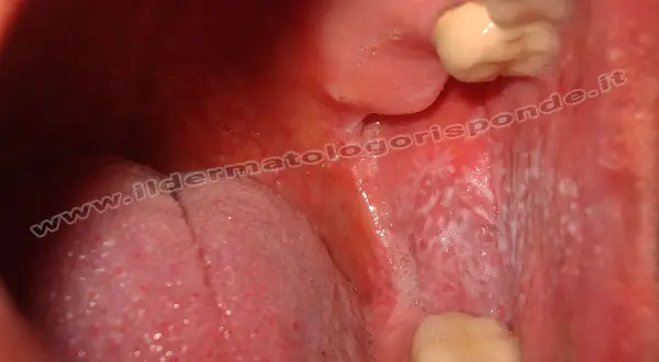 Lesione reticolare bianca sulla mucosa orale, tipica del lichen planus.