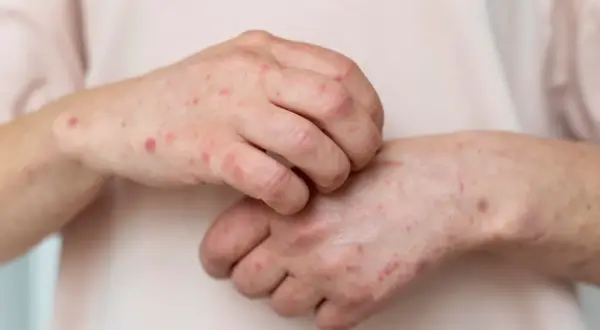 Manos con erupciones rojas y picazón, indicativo de piel atópica.