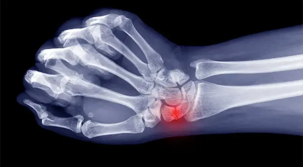 Röntgenbild einer Hand mit hervorgehobenem, entzündetem os triquetrum.