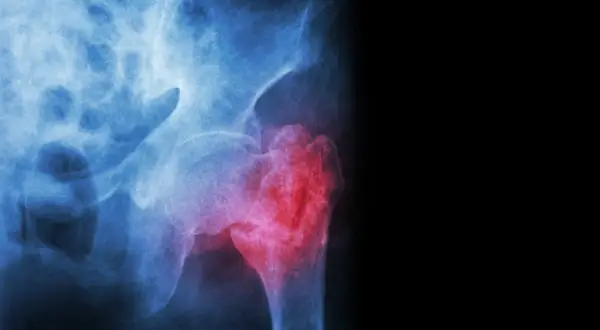 Radiographie du bassin montrant une fracture du col du fémur, marquée en rouge pour indiquer la douleur et la lésion.