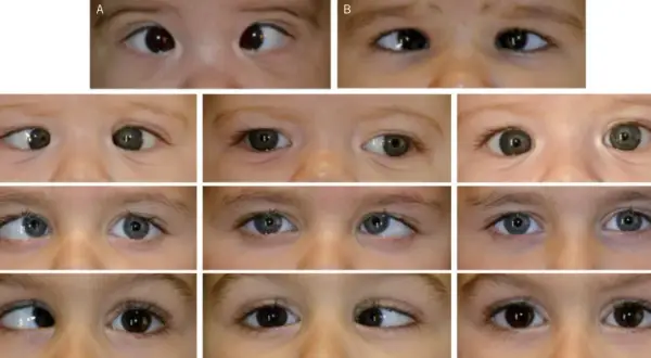 Primeros planos de ojos de bebés y niños pequeños, mostrando diferentes tipos de estrabismo en niños de 1 a 2 años.