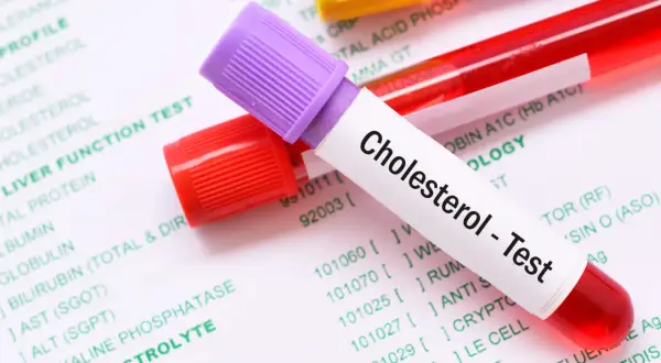 Probówki z krwią na tle dokumentu z badaniami. Jedna probówka ma etykietę "Cholesterol - Test". To pokazuje, lipidogram co to jest.