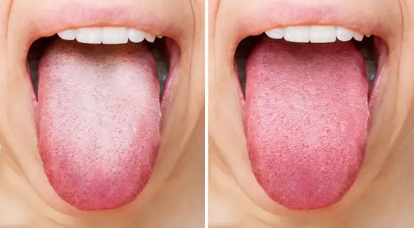 Confronto tra una lingua bianca e una lingua sana e rosa. La lingua gialla può indicare problemi di igiene o salute.