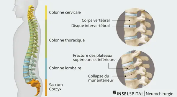 Illustration montrant une fracture vertèbre lombaire. Le temps de guérison dépend de la gravité de la lésion.