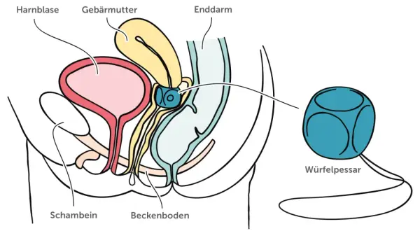 Schema des weiblichen Beckens mit Harnblase, Gebärmutter und Enddarm. Ein Würfelpessar wird gezeigt, dessen Nachteile hier nicht thematisiert werden.