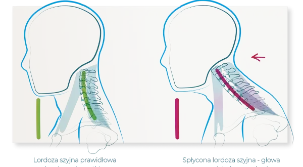 Prawidłowa lordoza szyjna z brodą nad mostkiem vs. spłycona lordoza szyjna z wysuniętą głową. Ilustracja pokazuje zniesienie lordozy szyjnej.