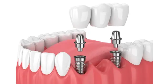 Model szczęki z widocznymi implantami zębowymi i mostem protetycznym. Implant zęba to nowoczesne rozwiązanie.