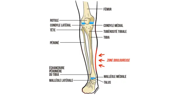 Anatomie du tibia avec une zone douloureuse marquée, typique de la douleur au tibia chez un débutant en course à pied.